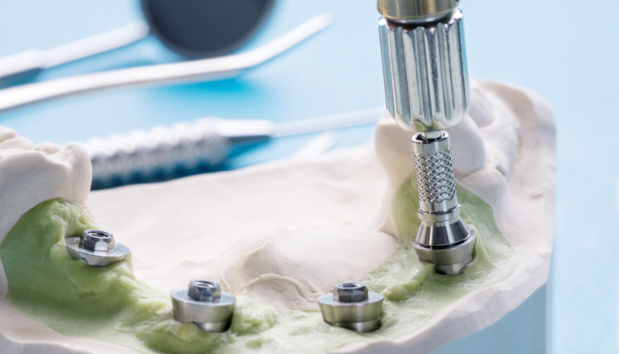 Immediate Implants and Restorations in Mumbai – Dr. Aditi Chhajed