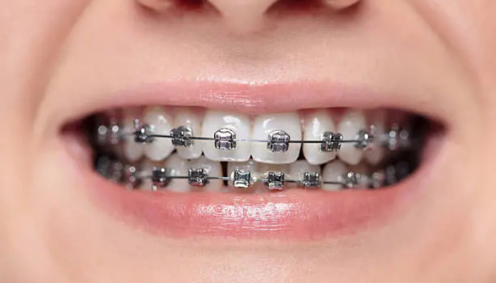 Orthodontic Treatment and Braces in Mumbai – Dr. Aditi Chhajed