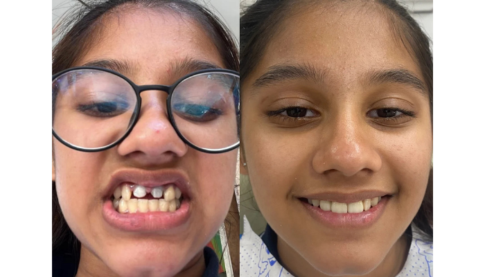 Dental Implants in Mumbai – Dr. Aditi Chhajed