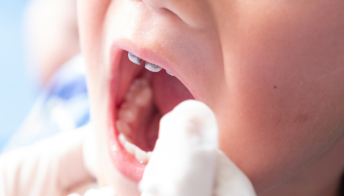 Dental Implants in Mumbai – Dr. Aditi Chhajed