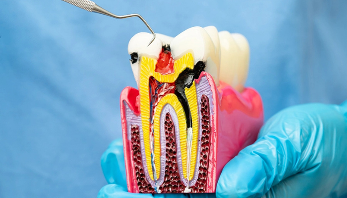 Root Canal Treatment – Dr. Aditi Chhajed Mumbai