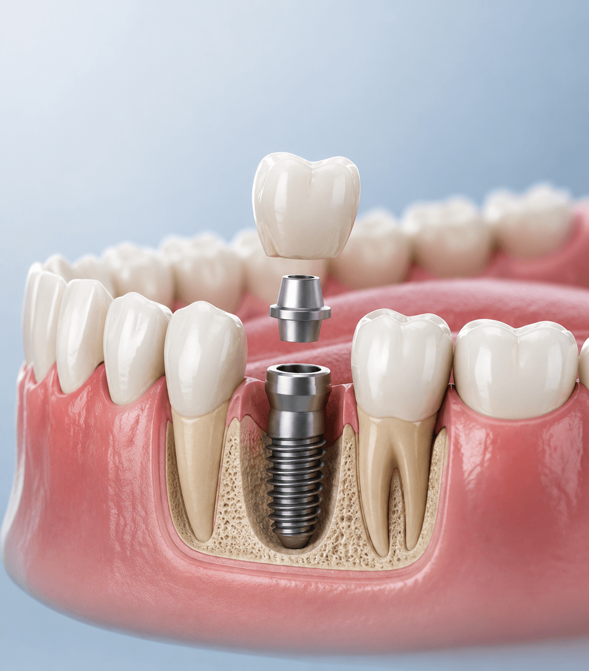 Who needs dental implants explained by Dr. Aditi Chhajed, Implantologist for missing teeth treatment